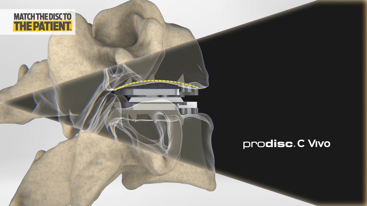 prodisc C Portfolio cervical disc replacement animation featuring the Match-the-Disc platform