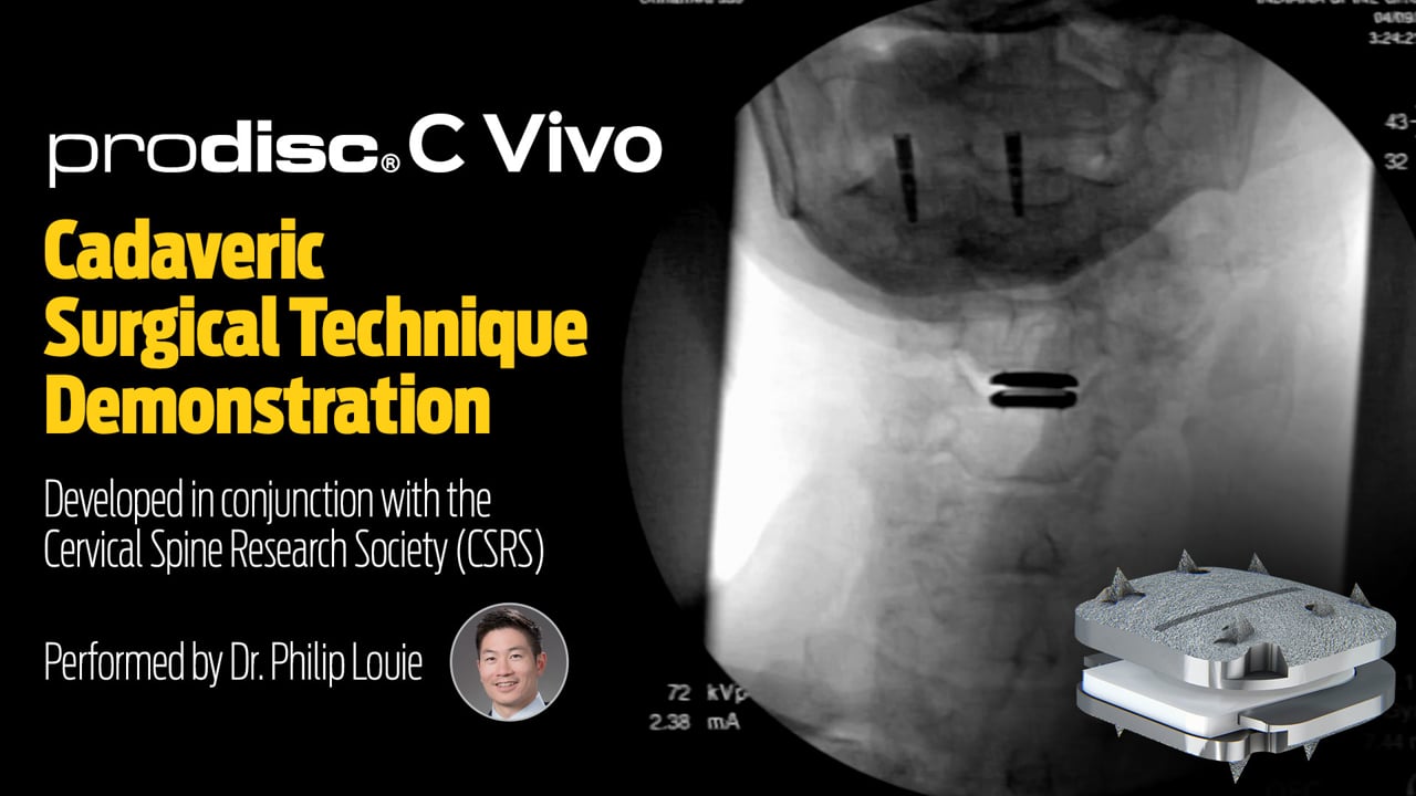 prodisc C Vivo cadaveric cervical disc replacement surgical technique demonstration